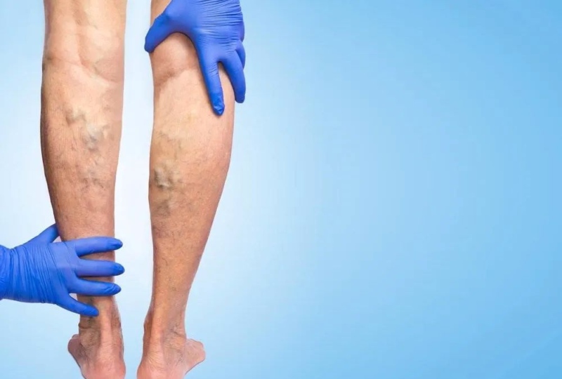 Яка причина варикозного розширення вен