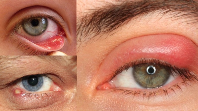 Очі під загрозою: як безпечно позбутися ячменю і зберегти зір