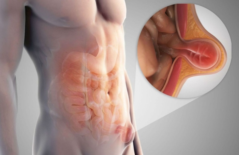 Коли актуальне хірургічне видалення грижі