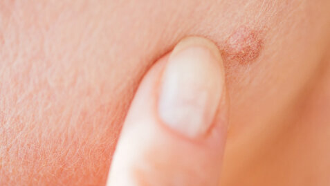 Що буде, якщо здерти родимку: можливі наслідки та ризики